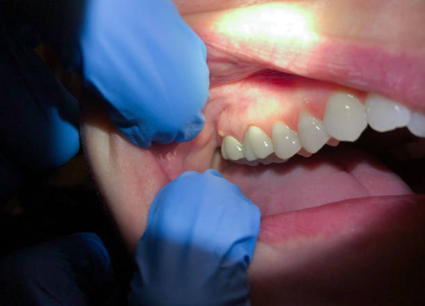 Best Emergency Dental Care for Broken or Chipped Teeth in Dunwoody, GA